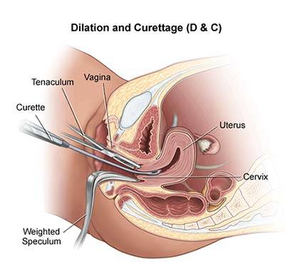 Dilation and Curettage (D&C) Specialist in Midtown, Manhattan, NYC