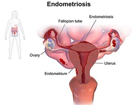 The Link Between Endometriosis and Abnormal Bleeding: Collaborative Women's  Care: Obstetrics and Gynecologist