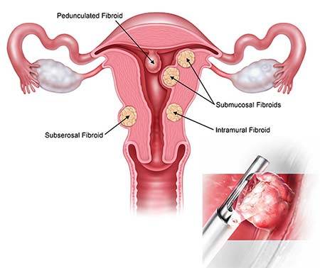 biopsy of polyp on uterus