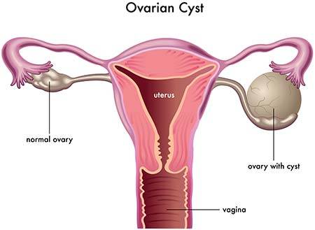 Hemorrhagic Ovarian Cyst: Care Instructions