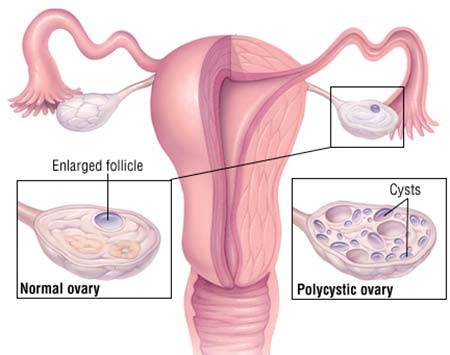 pcos ovary removal