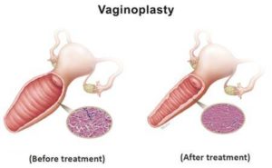 Vaginoplasty Manhattan Women S Health And Wellness Gynecology   Vaginoplasty 300x185 